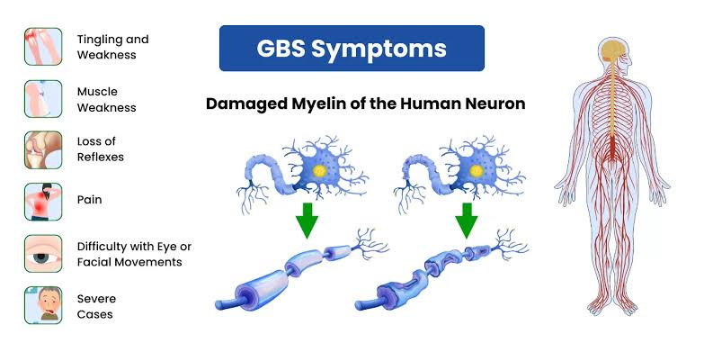 Guillain-Barré Syndrome in India: Symptoms
